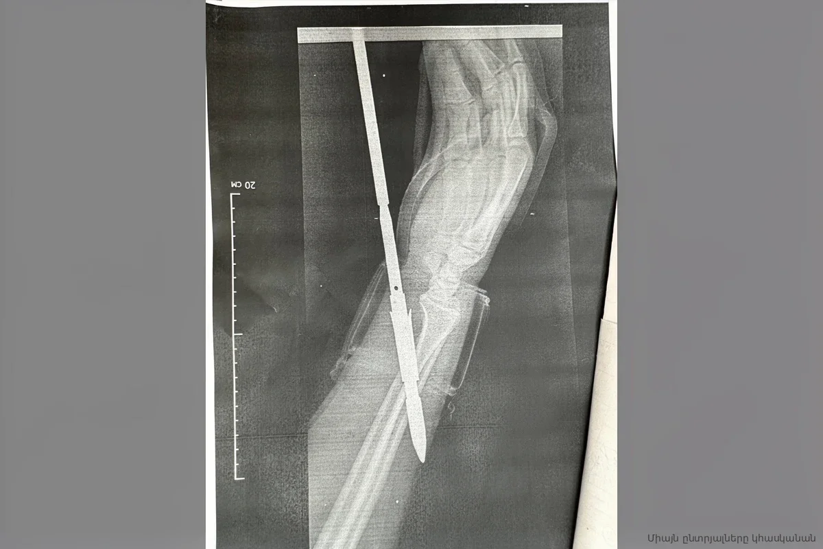 Орский рыбак прошил руку гарпуном: врачи оценили последствия выстрела в упор